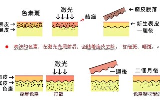 光子嫩肤斑点问题的解决方案

---

第一部分光子嫩肤简介
-**什么是光子嫩肤？**
-定义光子嫩肤是一种利用特定波长的光能量来改善皮肤质地和外观的非侵入性治疗方法。
-技术原理通过选择性光热作用，针对皮肤中的色素、血管等进行治疗。

-**光子嫩肤的适应症**
-常见的皮肤问题色素沉着、雀斑、晒斑、细纹、毛孔粗大等。
-治疗效果改善肤色不均、提亮肤色、减少细纹和毛孔。

---

第二部分斑点问题概述
-**斑点的类型**
-雀斑遗传因素，常见于面部。
-晒斑紫外线暴露导致的色素沉着。
-